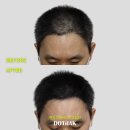 한올눈썹탈모커버 아카데미본점 | 압구정 SMP 자연스럽게 탈모 커버하는 진짜 방법