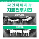 파인타워치과의원 네이버블로그