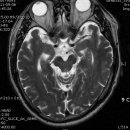 PCA terrotory infartion + AchA territory 이미지