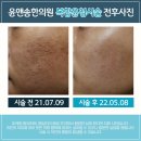 여드름 흉터 한의원 치료 가격 부터 방법까지 총정리