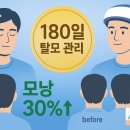 6-180 TS | 탈모 관리 트렌드: 180일 집중 케어, 실제 효과는?