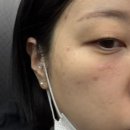 라임약국 | 서울 편평사마귀 성지 유온느의원 듀오덤 vs 비판텐 관리법까지 총정리 후기