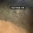 매직헤어라인 이미지