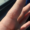 한포진 원인 및 증상 치료 : 손가락 손바닥 발바닥 발가락 물집(수포) 이미지
