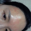 피부과 시술후 부작용 이미지