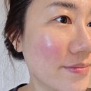 미주병원 | 미아역 한의원 통증없는 스킨부스터 미주안약침 후기