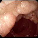 직장용종(Tubular adenoma, with focal high-grade dysplasia) 이미지