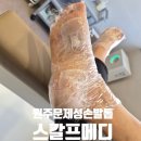강원메디 | 원주 문제성 손발톱 관리 가능한 스칼프메디 발각질 후기