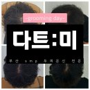 부산 SMP 두피 문신 전문샵 &#39;다트:미&#39; 정수리 풍성해지기 1회차 리뷰