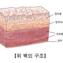 위궤양 (Gastric Ulcer) 이미지