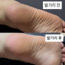 공구Da | 홈케어로 발뒷꿈치 각질제거하기 (+발가리 비밀공구링크)