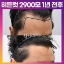 [30대 남자 넓은 M자탈모 헤어라인 모발이식] 비절개 히든컷 2900모 2주,3개월,1년 후기 (모엠의원/M자탈모/전지훈원장) 이미지