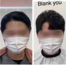 모로미용인 | 탈모머리 남자 가발을 벗기위한 6개월간의 노력