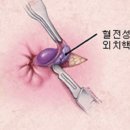 혈전성 치질(외치핵) 수술