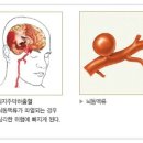 뇌동맥류 이미지