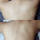 모던케어 | 등드름 흉터 완벽 제거, 솔에스테틱 부천점 등드름 케어 후기