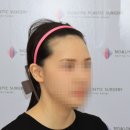 닥터진앤모의원 | 높은 이마·M자 여성 헤어라인 모발이식 후기｜얼굴 비율을 고려한 디자인