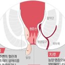 혈변 원인 (선홍색 혈변, 흑변) 이미지