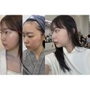 신논현피부과 우유빛의원 환공포리쥬란 솔직후기: 리쥬란힐러 통증/후기/효과/부작용