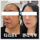 리뉴메디칼 대구지사 | 대구 피부관리 제대로 된 리프팅 "아미뷰티센터" 티리온X 온다리프팅급 효과