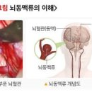 뇌동맥류 어떤 이 있을까 이미지