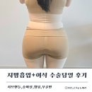 드디어 D-DAY 허벅지 지방흡입+허파고리 리얼 당일 후기(통증, 멍, 붓기)