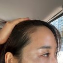 일산 헤어라인 두피 추천 크레센트421 후기