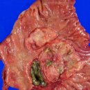 ?위, 샘암 胃腺癌 Stomach, Adenocarcinoma 이미지