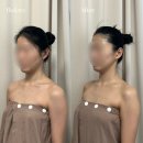 케렌시아 솔 | 광주 웨딩관리 1회 비교전후 윤곽부터 일자어깨 관리까지