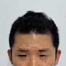 경주 탈모관리 헤어라인, 가르마 채우기 스테이스튜디오 1차, 2차 방문 후기