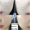 피부에 두드러기나 벌레 물린것 같은 자국 문의드립니다호텔 첫날이후 이런 상처?가 몸에 계속 번지네요...