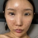 (주)에스피네이쳐 2공장 | 여드름 레이저,약,연고,염증주사, 식단 다 써본 자의 후기