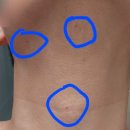 세종스노우의원 | [세종 스노우의원] 하루 30분, 2주 기다림으로 점 영영 안녕