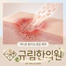 청주 피부관리 한의원 : 여드름 흉터 생성 원리, 염증은 어떻게 피부를 파괴하는가?