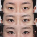 그리다성형외과의원 | 강남쌍꺼풀수술 자연유착 눈매교정 일주일차부터 두달차 후기