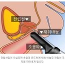 정액에서 피가 섞여 나온다면(비뇨기과) 이미지