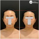 샤넬경락 | [피부관리] 웨딩관리로 인기많은 위뷰티 발사지 얼굴경락 솔직후기 (전후사진, 효과, 통증)