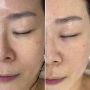 유원메디칼 | [목동 플라즈마] 쟈민뷰티에서 받은 콜드플라즈마 효과 짱짱