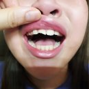 석촌동 이튼치과의원 어린이치과 치료, 불소도포 후기