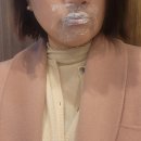 다산수정 | [ 다산피부과 ] 입술필러 얇은 입술 변신 찐 후기