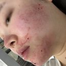 청룡한의원 | [임신바우처사용처] 일산 후한의원 임산부여드름, 내돈내산 솔직후기