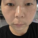 멍단장 | 리쥬란 효과시기와 멍 주사자국 관련 2주차 청담역피부과 물광주사 후기