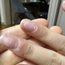 안심 2 사마경로당 | 아임힐 사마킬 율무크림 (초딩손가락 사마귀 없애는 방법) 2달 솔직후기 효과 만족!!