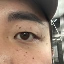 서면한의원 | 부산 서면편평사마귀제거 한의원 솔직후기