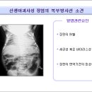 신생아 괴사성 장염 이미지