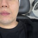 씨의원 | 옥수동 남자 제모 피부과 BBL 제모 1회차 밀락씨의원 후기 (통증, 가격)