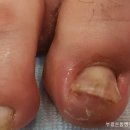 손톱쟁이,발톱쟁이