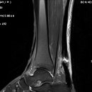 Achilles tendon rupture.. 이미지