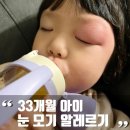 33개월아이 눈 모기 알레르기 안과 성형외과 약처방 후기