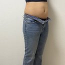 고리 | 복부지방흡입 허파고리후기 라인이 달라진 진짜 변화